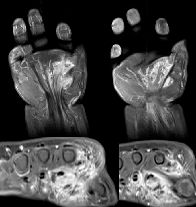 Figure 3 for case Fibrous hamartoma of infancy